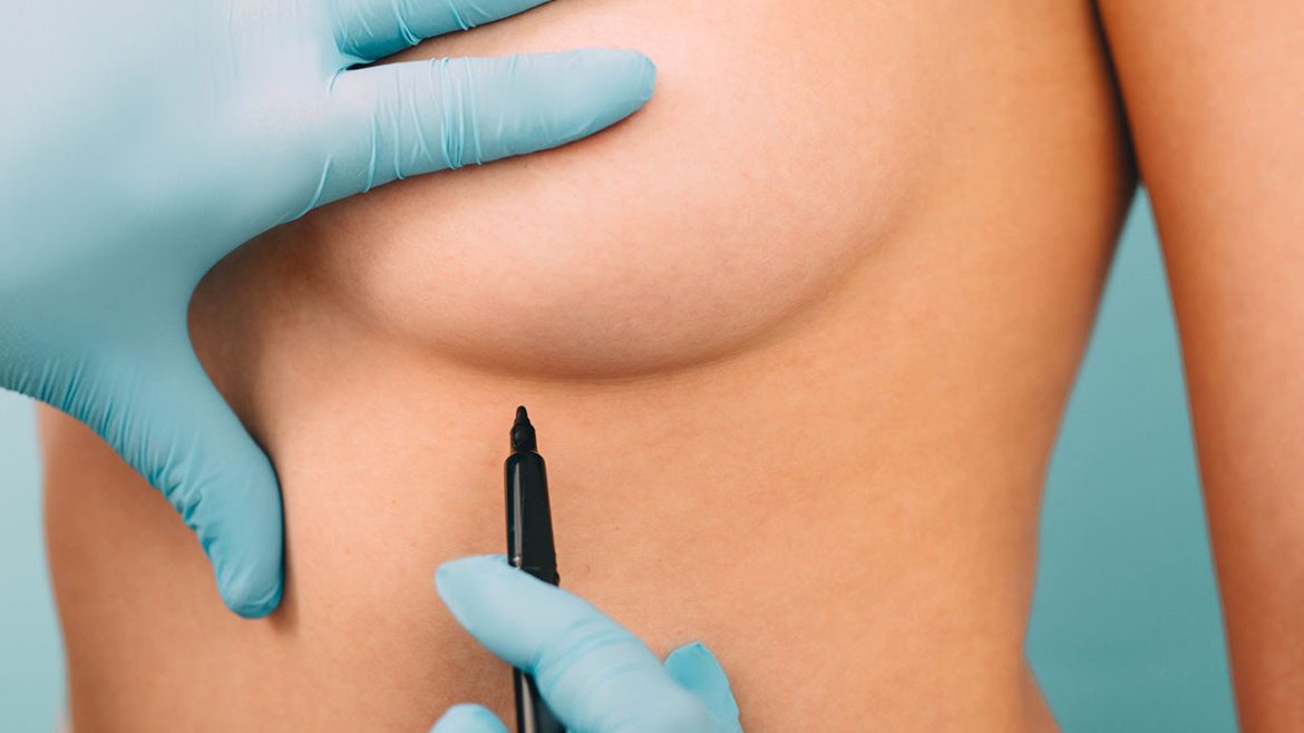 BREAST FILLER