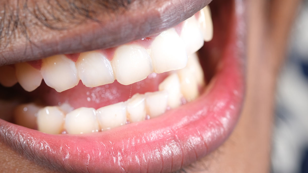 TEETH WHITENING